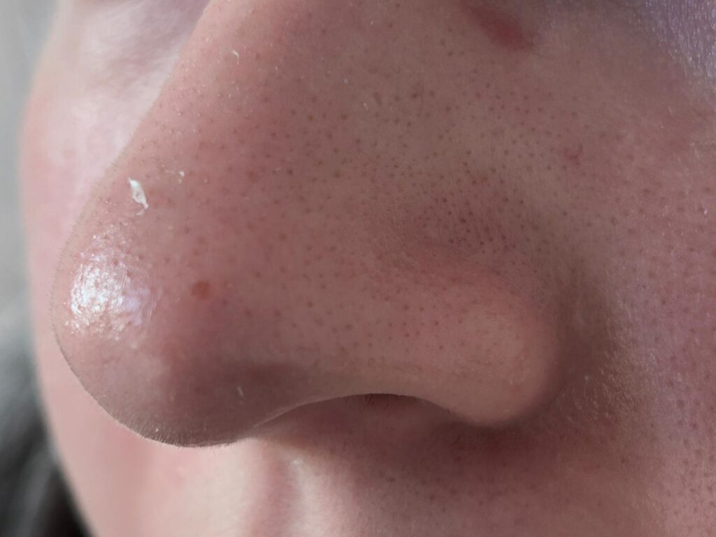 nasul meu plin de puncte nerge