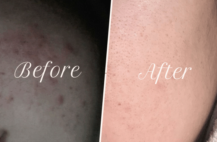 before and after accutane