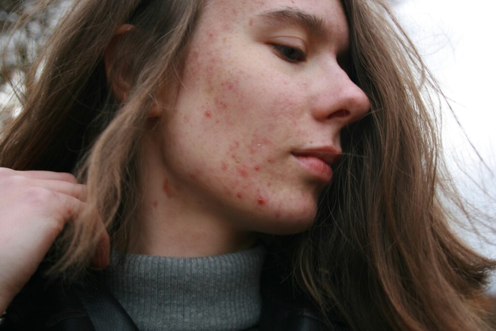 acne skin